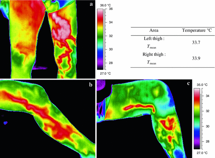 Termokamera visszér előtt/után